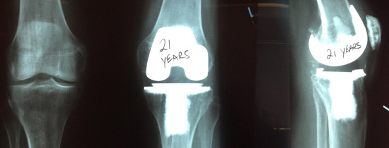 knee_zps28gw040g.jpg