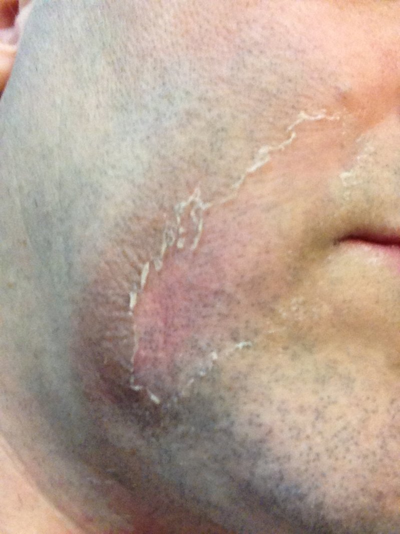 Face Burn.JPG